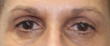 Left Upper Eyelid Internal Ptosis (Post-Operative Week 2) Before