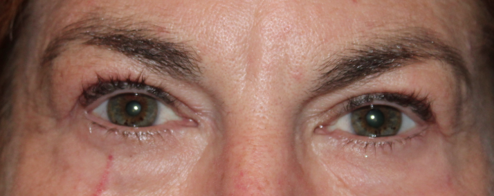 Bilateral Upper Eyelid External Ptosis (Post-Operative Month 2) After