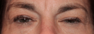Bilateral Upper Eyelid External Ptosis (Post-Operative Month 2) Before