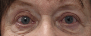 Right Upper Eyelid Ptosis Repair (Post-Operative Month 3) After