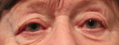 Right Upper Eyelid Ptosis Repair (Post-Operative Month 3) Before