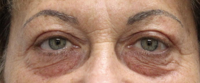 Bilateral Upper Eyelid Ptosis Repair (Post-Operative Month 2) After