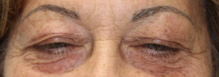 Bilateral Upper Eyelid Ptosis Repair (Post-Operative Month 2) Before