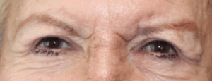 Bilateral Upper Eyelid Ptosis Repair (Post-Operative Month 2) After