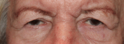Bilateral Upper Eyelid Ptosis Repair (Post-Operative Month 2) Before