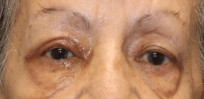 Bilateral Upper Eyelid Ptosis Repair (Post-Operative Week 1) After
