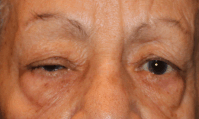 Bilateral Upper Eyelid Ptosis Repair (Post-Operative Week 1) Before