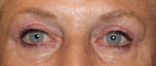 Bilateral Upper Eyelid Ptosis Repair (Post-Operative Month 4) After