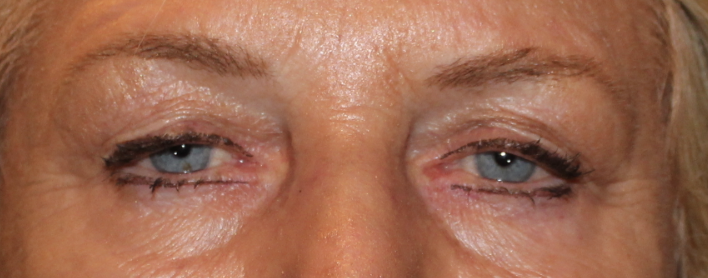 Bilateral Upper Eyelid Ptosis Repair (Post-Operative Month 4) Before