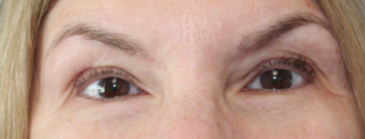 Left Internal Ptosis Repair- (Post-Operative Month 4) After