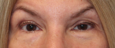 Left Internal Ptosis Repair- (Post-Operative Month 4) Before