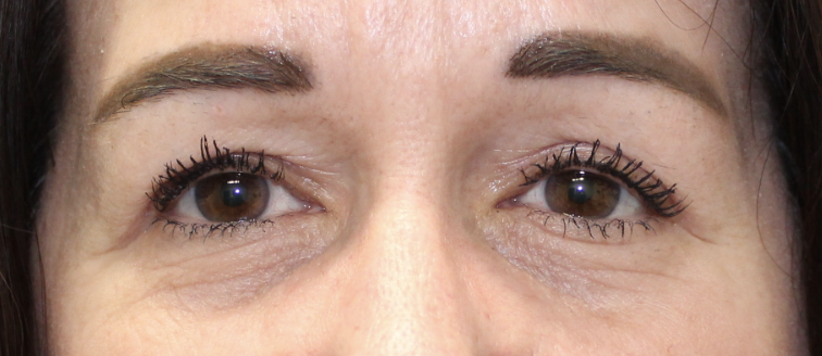 BUL Ptosis Repair - (Post-Operative Month 3) After
