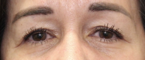 BUL Ptosis Repair - (Post-Operative Month 3) Before