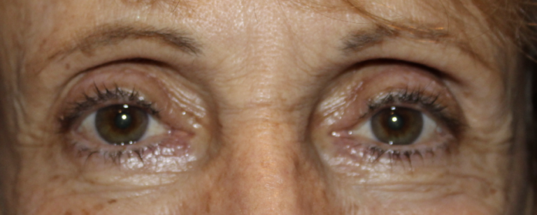 BUL Ptosis Repair - (Post-Operative Month 1) After