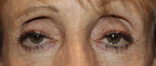 BUL Ptosis Repair - (Post-Operative Month 1) Before