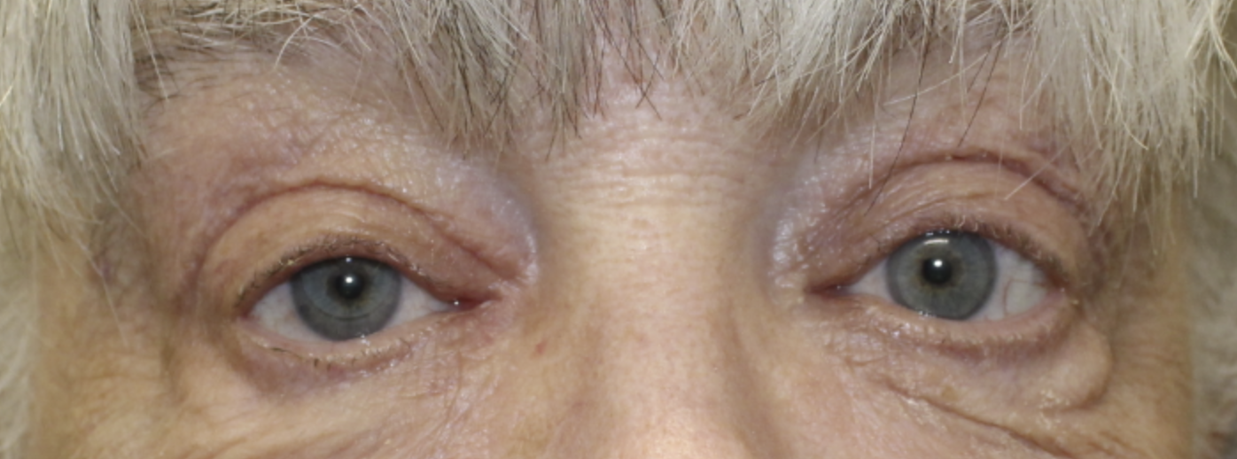 BUL Ptosis Repair - (Post-Operative Month 2) After