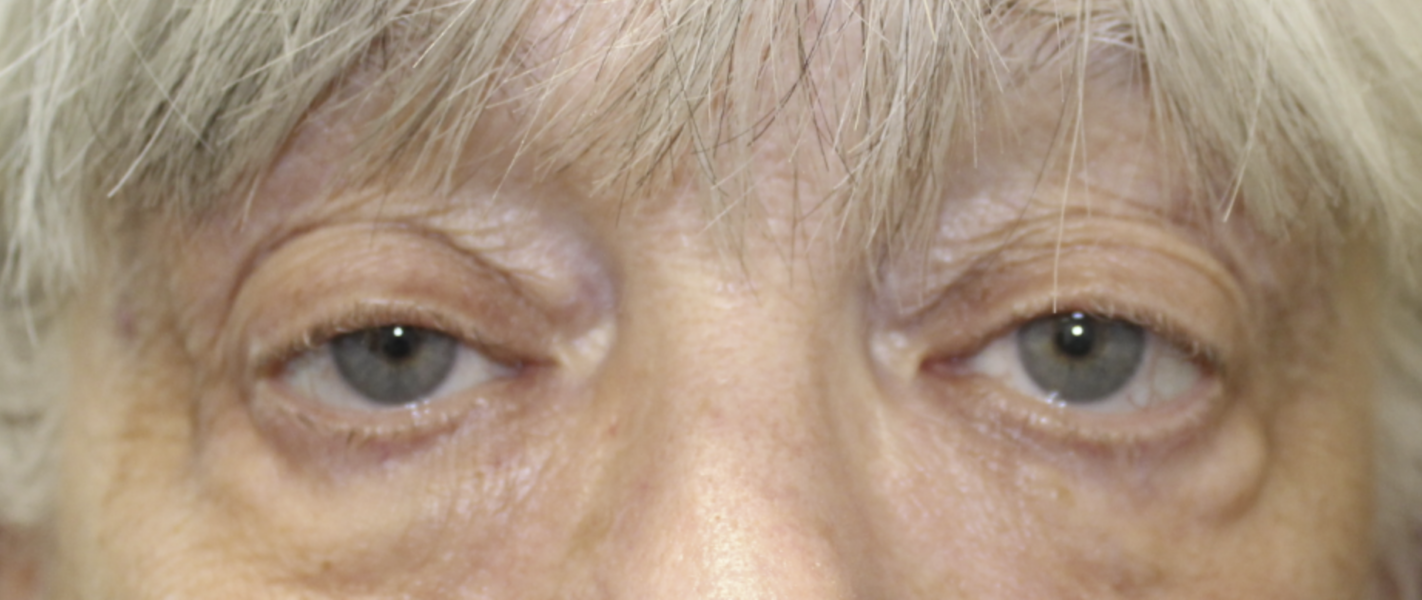 BUL Ptosis Repair - (Post-Operative Month 2) Before