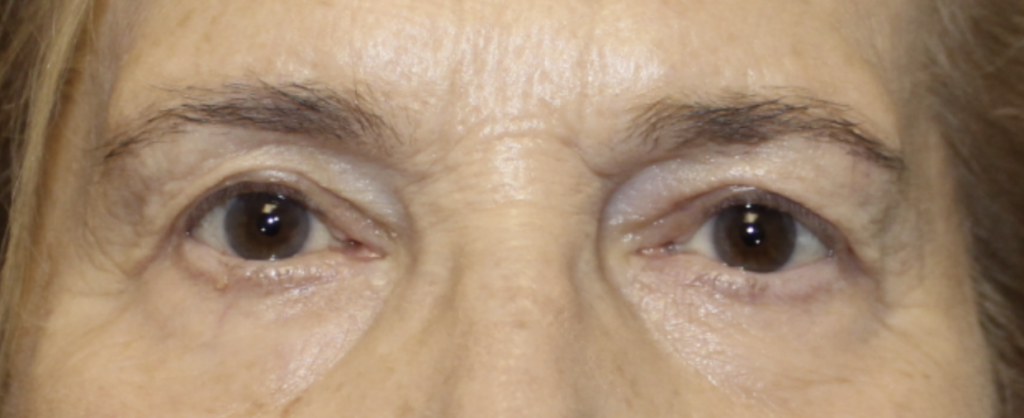 BUL Ptosis Repair - (Post-Operative Month 2) After