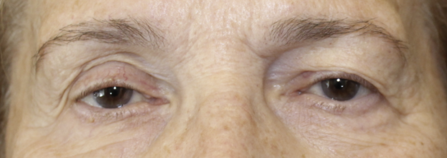 BUL Ptosis Repair - (Post-Operative Month 2) Before