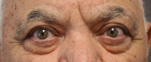 BUL Ptosis Repair After