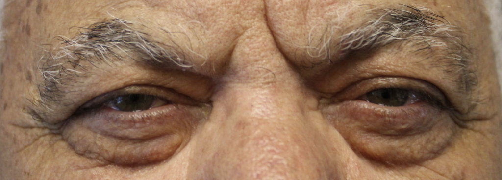BUL Ptosis Repair Before
