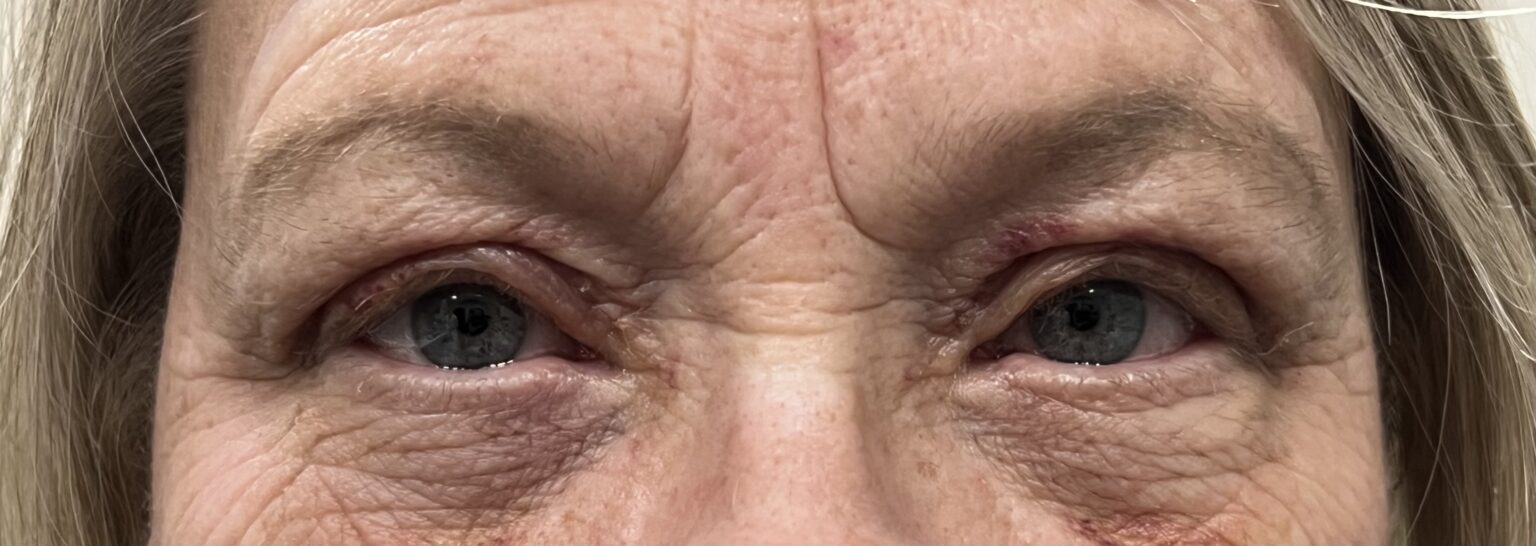 Ptosis Repair - (Post-Operative Week 1) After