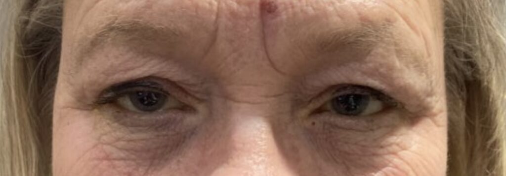Ptosis Repair - (Post-Operative Week 1) Before