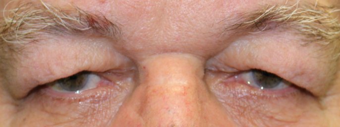 Upper Blepharoplasty Before
