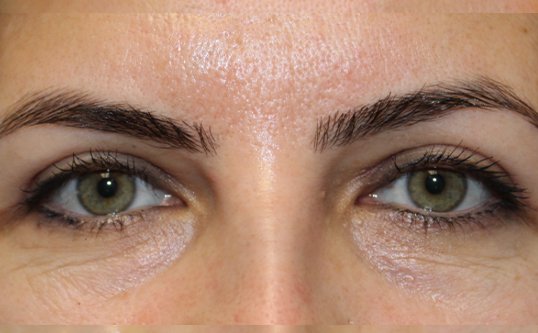 Upper Blepharoplasty After