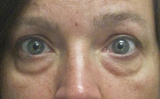 Lower Blepharoplasty Before