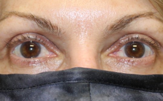 Ptosis repair on upper eyelids. After
