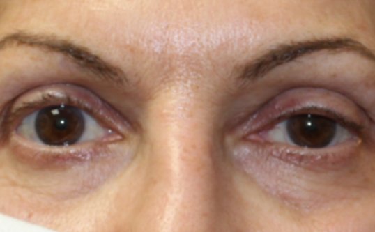 Ptosis repair on upper eyelids. Before