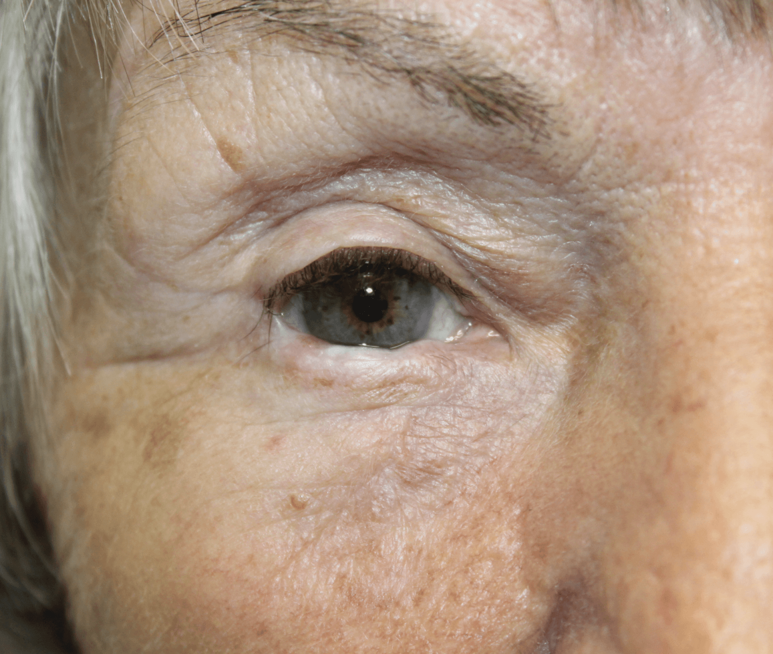 Removal of Squamous Cell Carcinoma 12 Months Later