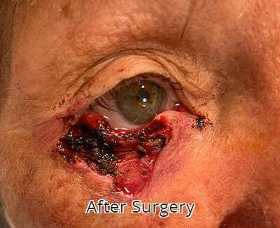 Removal of Squamous Cell Carcinoma After Surgery
