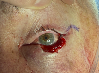 LLL Basal Cell Carcinoma with Mohs Surgery and Reconstruction (Post-Operative Month 1 Mohs