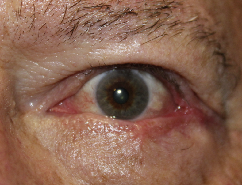 LLL Basal Cell Carcinoma with Mohs Surgery and Reconstruction (Post-Operative Month 1 After (1 Month)