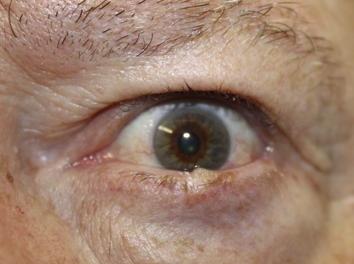 LLL Basal Cell Carcinoma with Mohs Surgery and Reconstruction (Post-Operative Month 1 Before