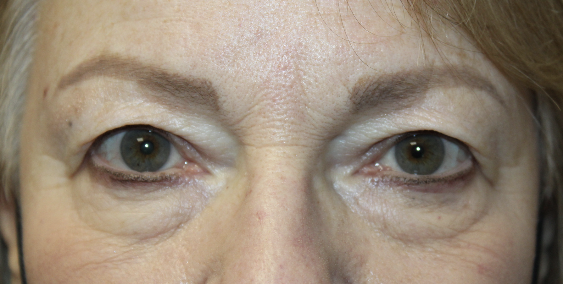 Upper and Lower Blepharoplasty with TCA peel Before