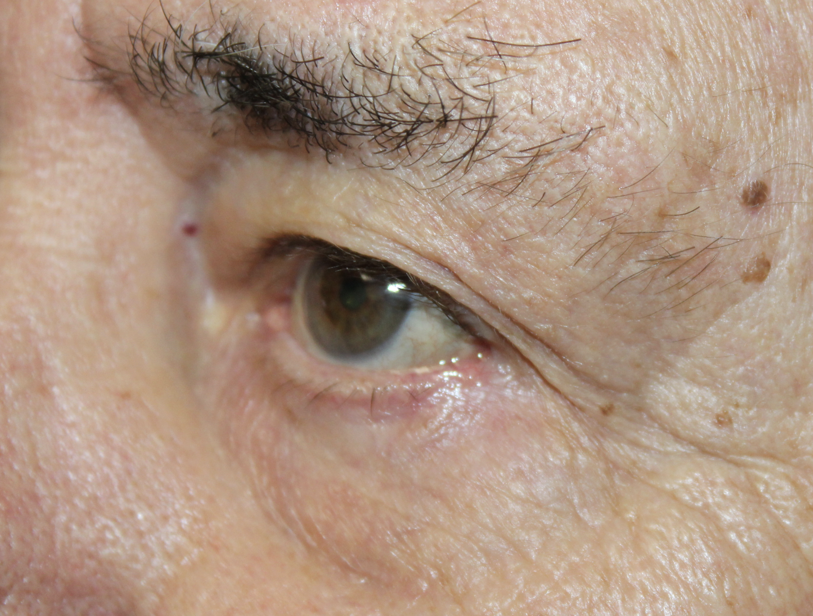 Eyelid Reconstruction After Skin Cancer Removal 2 Months After Surgery