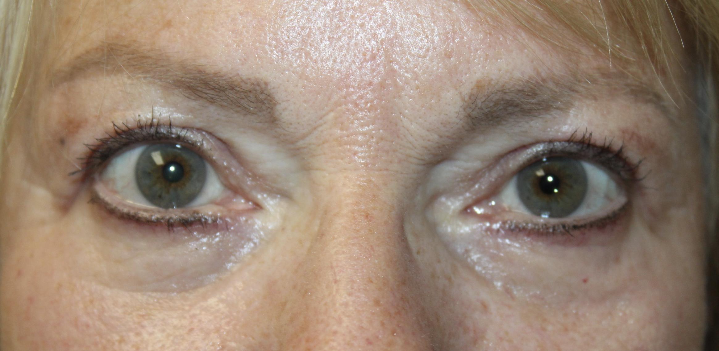 Upper and Lower Blepharoplasty with TCA peel After