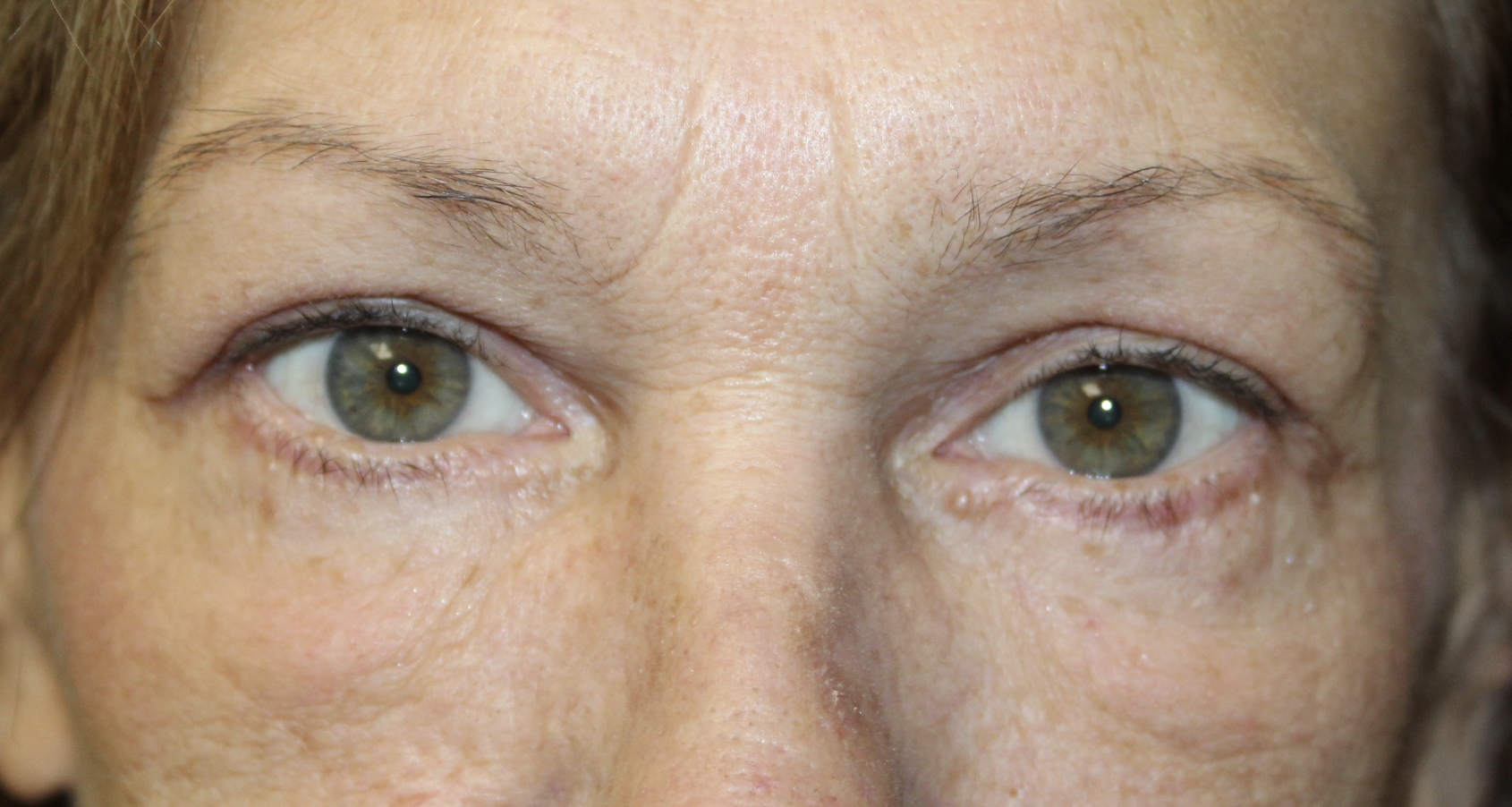 Upper and Lower Blepharoplasty with TCA Peel After