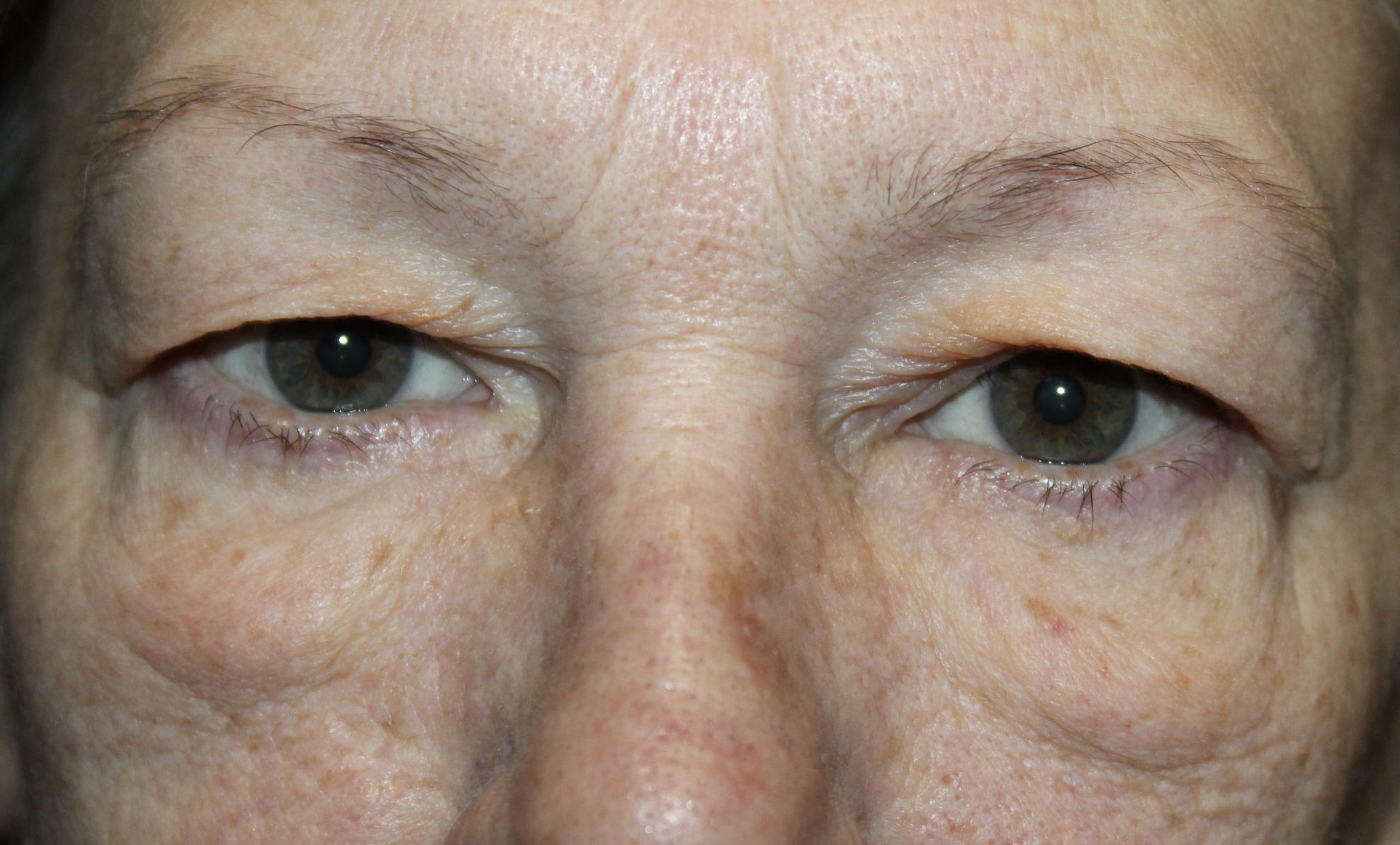 Upper and Lower Blepharoplasty with TCA Peel Before