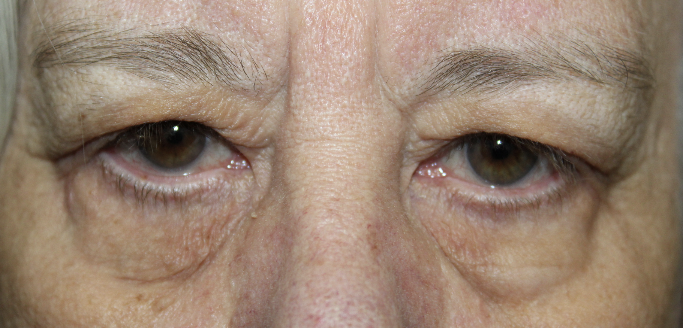 Upper and Lower Blepharoplasty Before