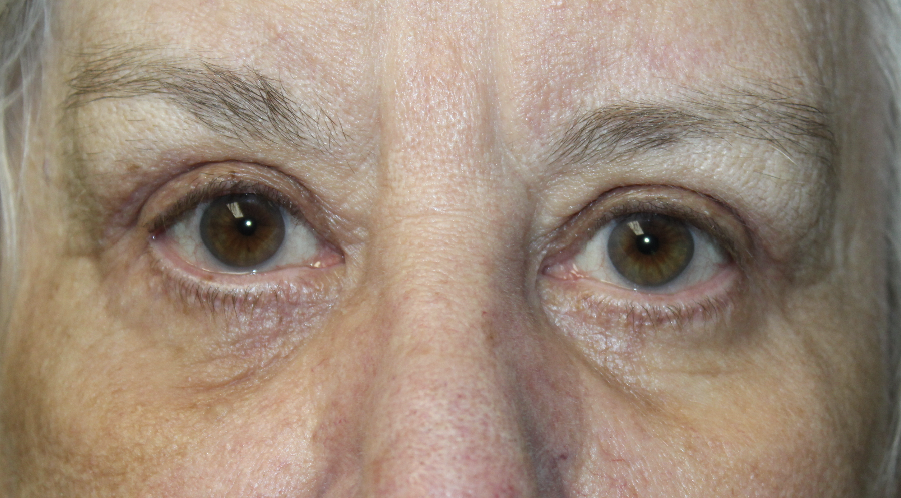 Upper and Lower Blepharoplasty After