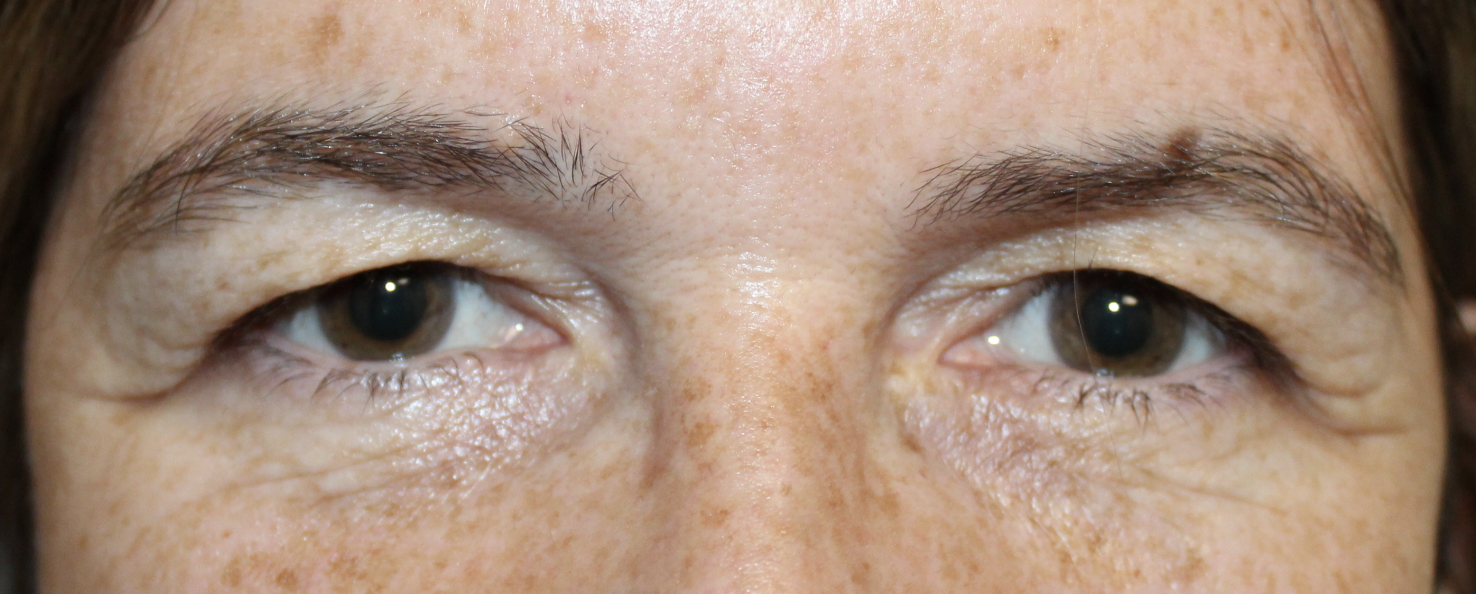 Upper Blepharoplasty Before