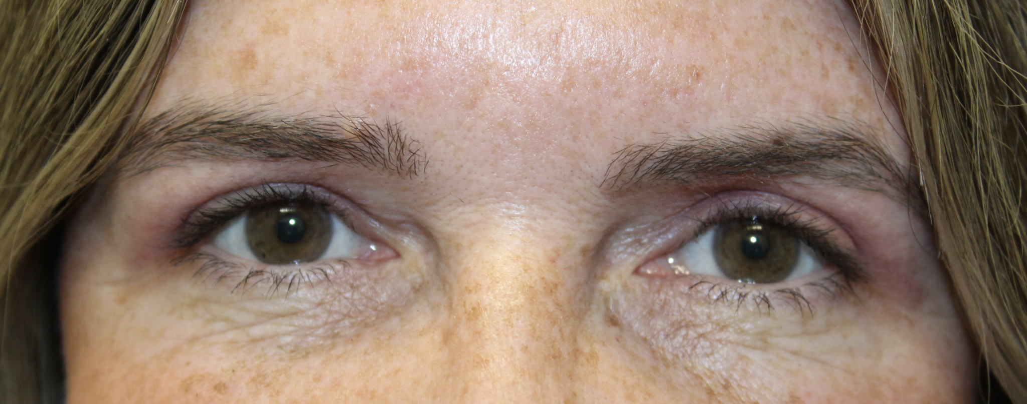 Upper Blepharoplasty After