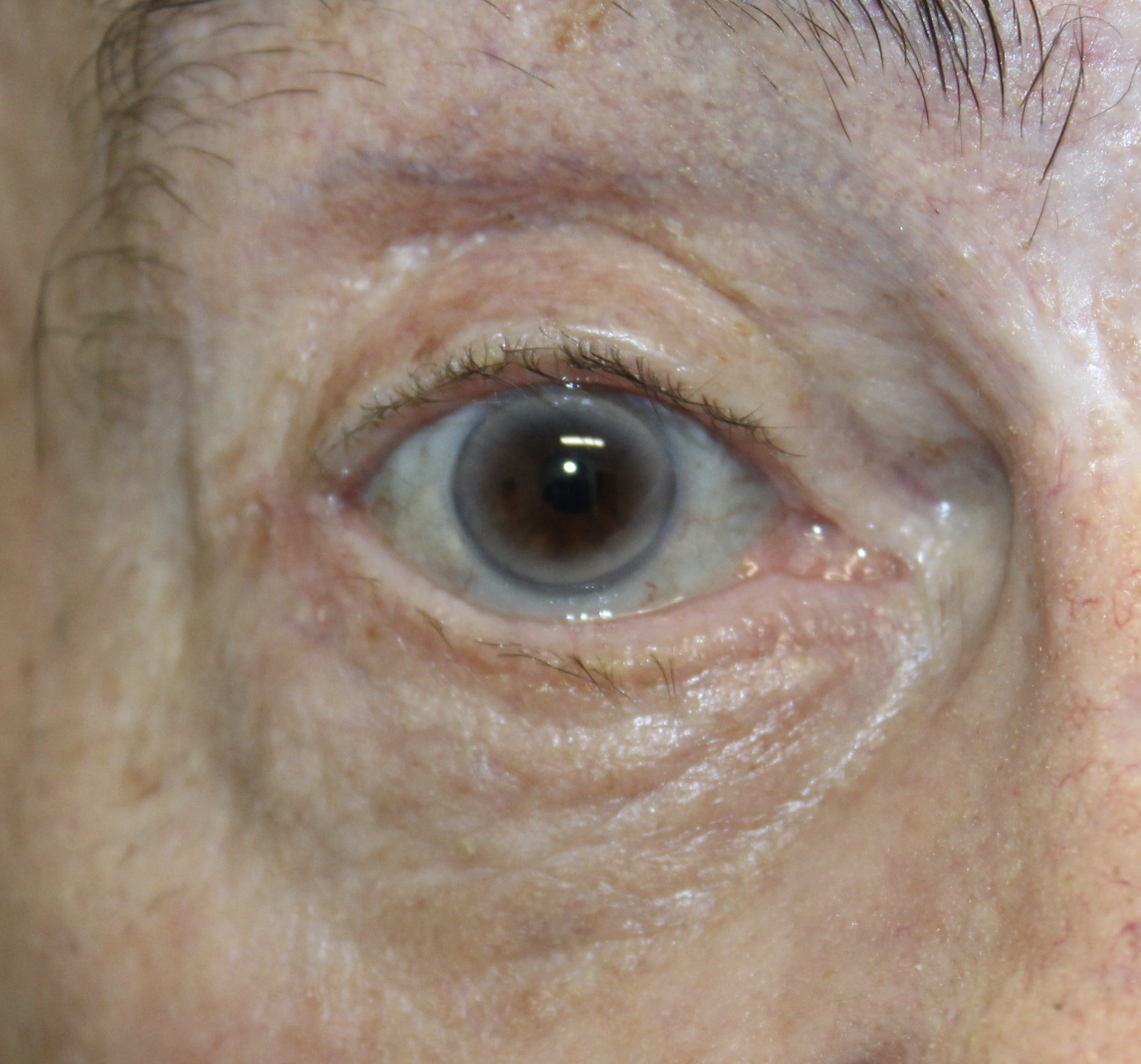 Ectropion with Skin Graft After
