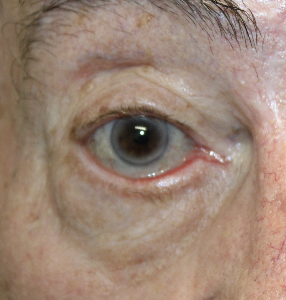 Ectropion with Skin Graft Before