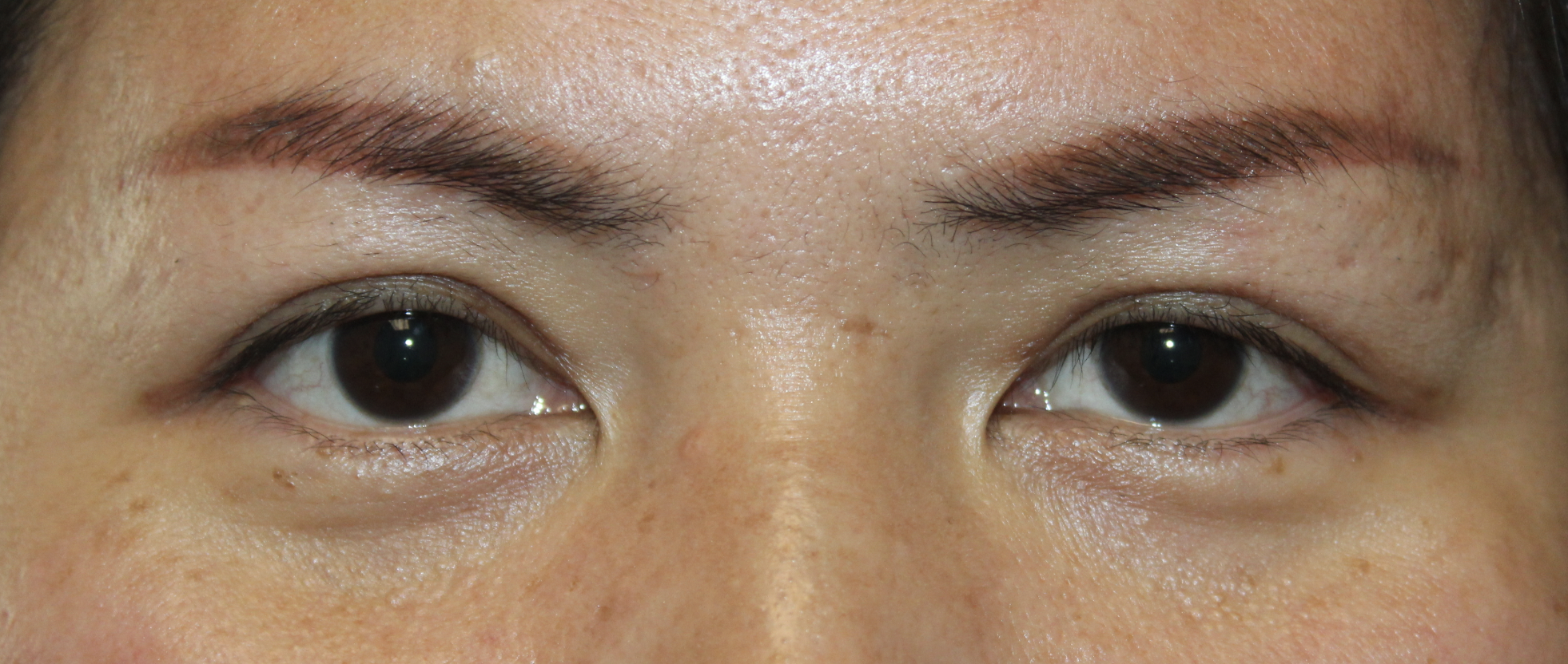 Asian Eyelid Blepharoplasty After