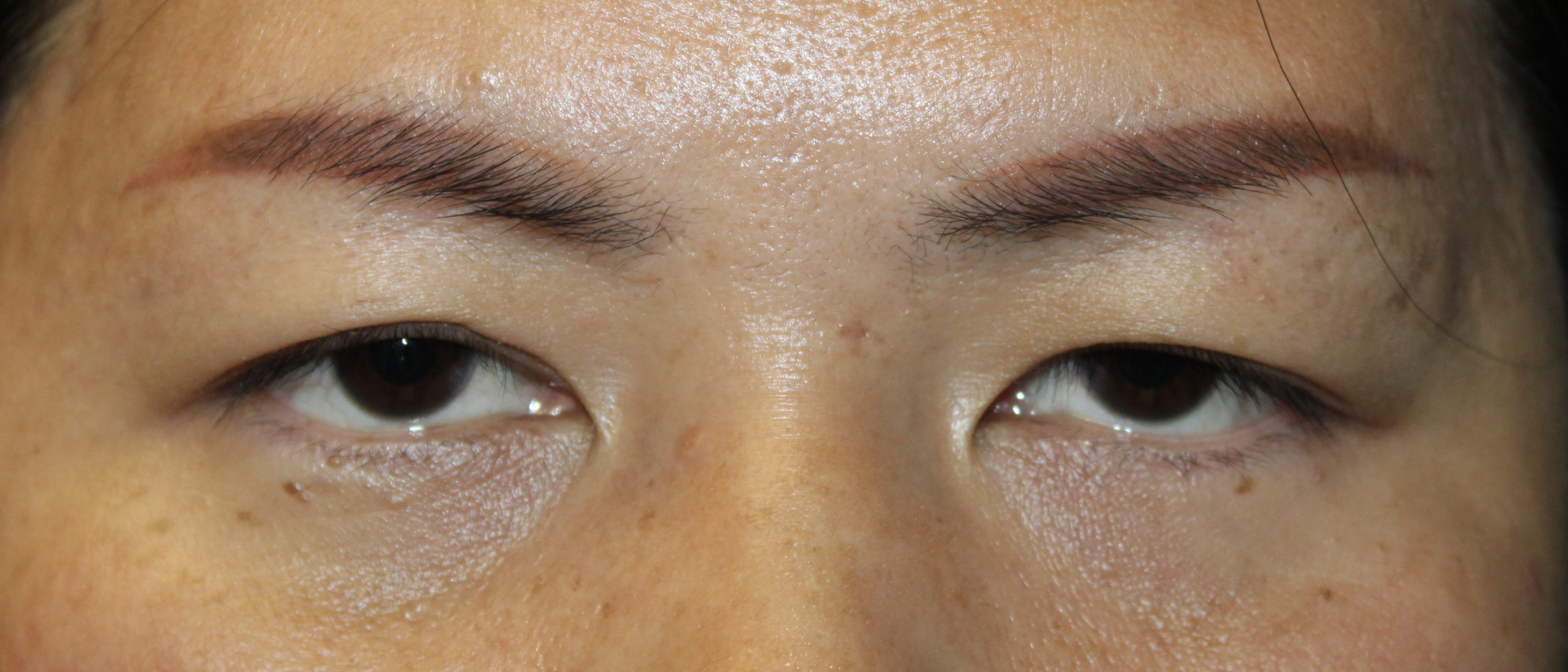 Asian Eyelid Blepharoplasty Before
